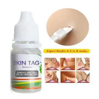 Skin Tag Removal